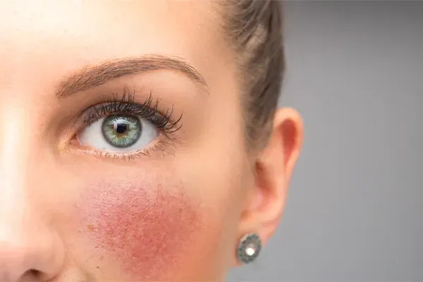 Rosacea-Doctor Close-up of a woman with rosacea on her cheeks. Schedule treatment for rosacea from Tanya Zboril, NP of TBT Medical in Halifax.