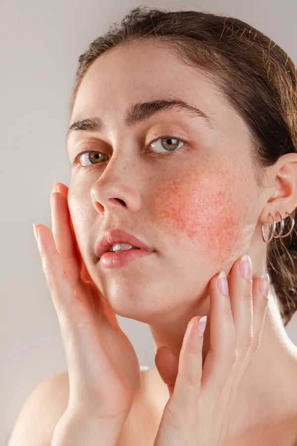 Rosacea-Treatment A women framing her face with her hands while inspecting her Rosacea. Receive IPL and Laser Treatment for Rosacea by Tanya Zboril, NP of TBT Medical in Halifax.